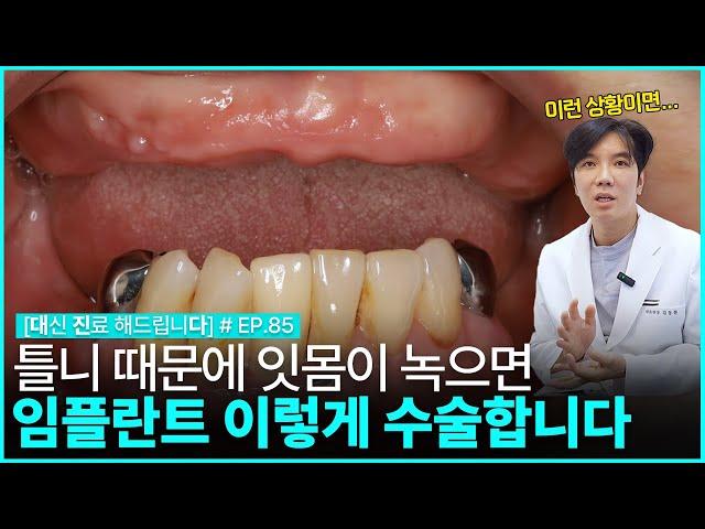 [대진다] 녹아버린 잇몸 무작정 수술하면 안됩니다..│틀니 부작용, 임플란트 수술과정, 앞니 임플란트, 임플란트 종류, 상악동 거상술│EP.85