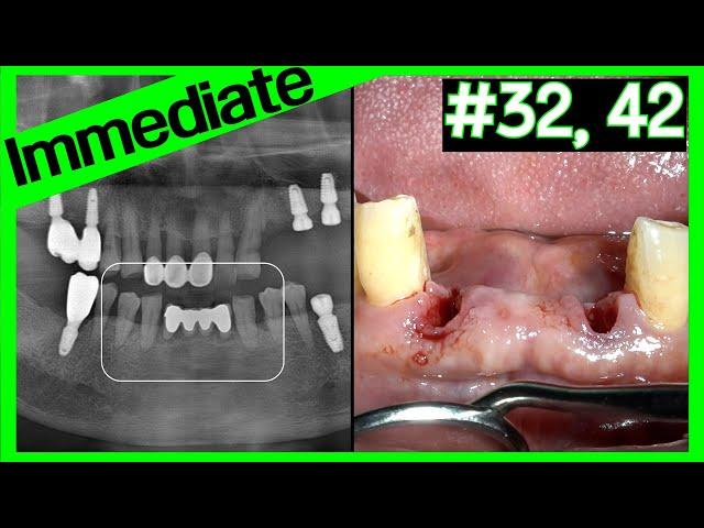 [Online Surgery] #32,42 Lower anterior immediate implant placement