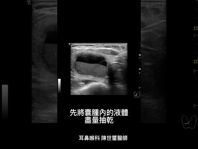 甲狀腺囊腫酒精注射術 耳鼻喉科 陳世璽醫師