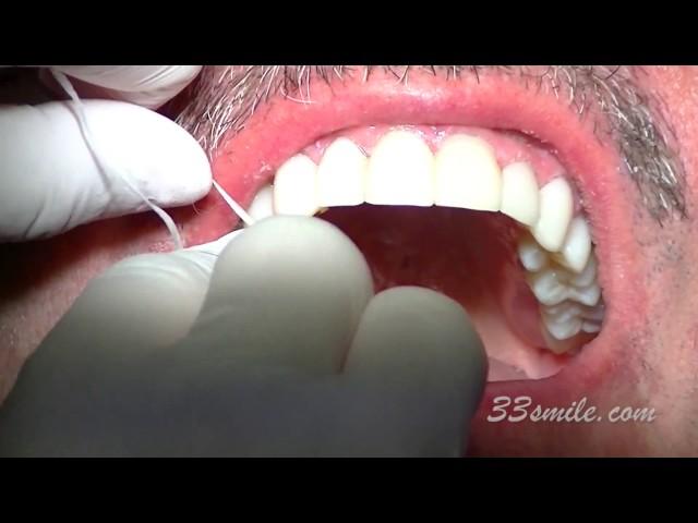 Video of Dr. John Moore Improving a Man's Teeth with Dental Veneers at  Cosmetic Dental Associates