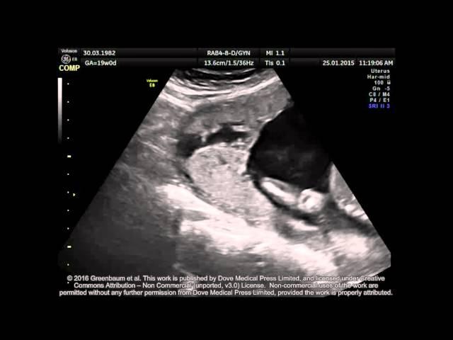 Sonography of placenta percreta (fourth pregnancy) – Video S1 [ID 100321]