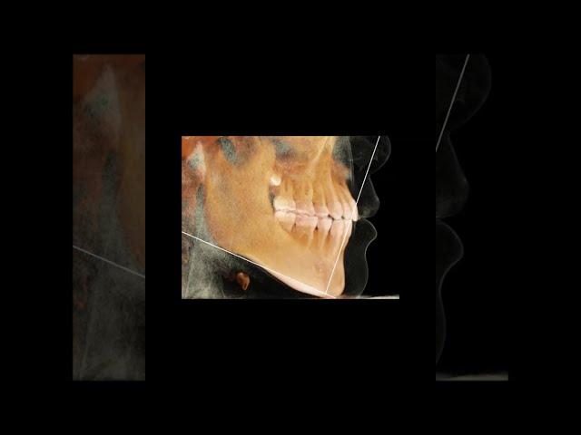 改訂版　CT KaVo 3D eXam and Anatomage Invivo5 software after orthodontic treatment