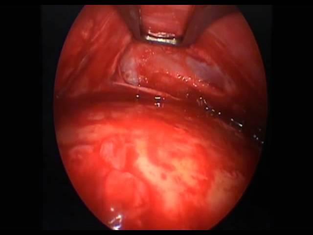 Endoscopic Resection of a Lipoma of the Forehead