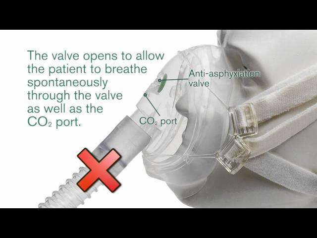 Intersurgical's FaceFit™ NIV mask with anti-asphyxiation valve