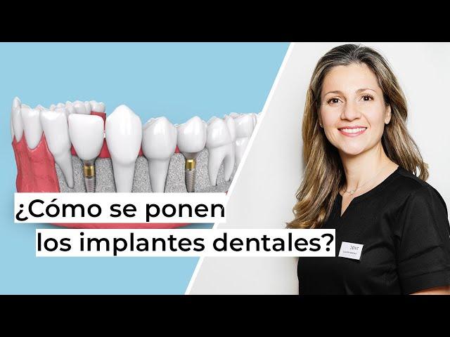 ¿Cómo se ponen los implantes dentales paso a paso? | Clínica dental en Alcobendas Avodent