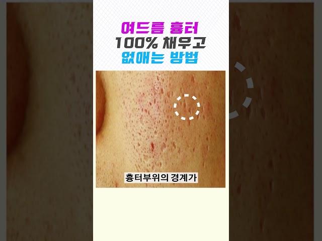  여드름 흉터 100% 채우고️없애는 방법  (여드름 닥터) #여드름흉터 #피부관리 #skincare #여드름흉터없애는방법