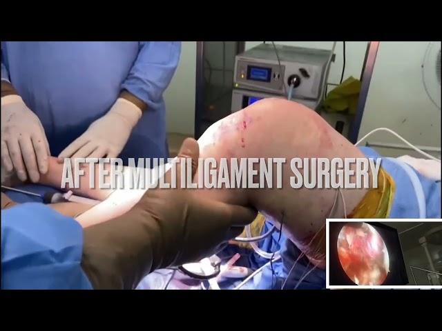 Complete tear ACL PCL MCL surgery in one stage! Dr Manit Arora you changed my life thank you