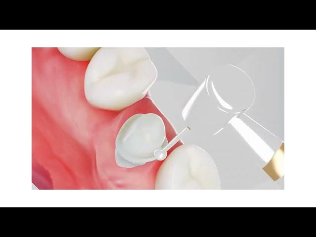 Dental Crowns