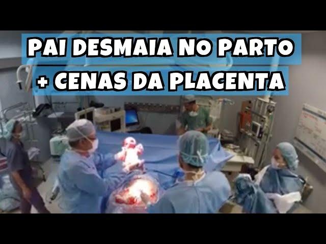 PAI DESMAIA DURANTE O NASCIMENTO - Vídeo de Parto Cesárea com cenas da placenta