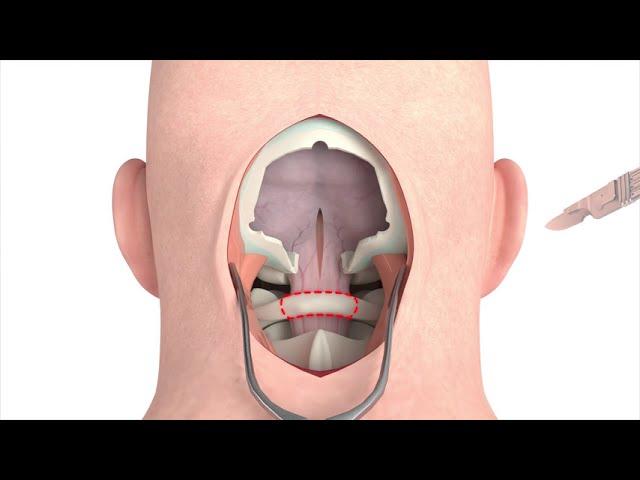 Craniectomy brain surgery - 3D animation