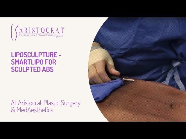 Liposculpture - SmartLipo for Sculpted Abs