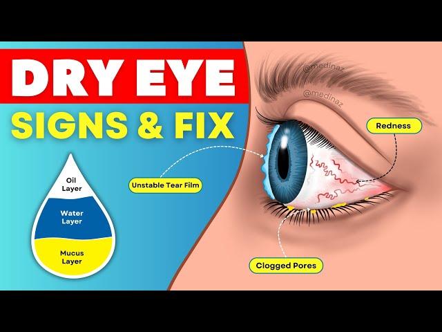 6 Dry Eye Signs You’re Ignoring  & Natural Ways to Fix it