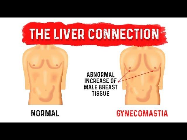 What is Gynecomastia (Man Boobs)? - Dr.Berg on Liver