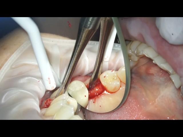 Guided Surgery Using Blue Sky Bio Safety Stopper Drills