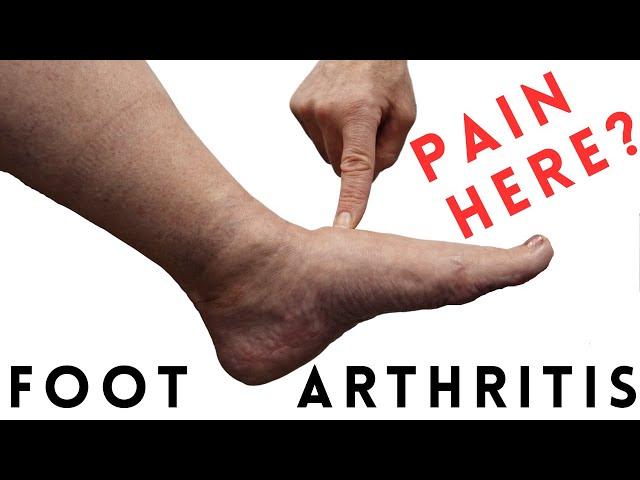 Foot Arthritis Pain: Most Common Signs and Symptoms