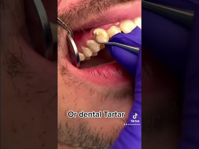 Dental cleaning, scaling #dentist #tiktok #video #viral #trending #shorts #youtubeshorts #youtube