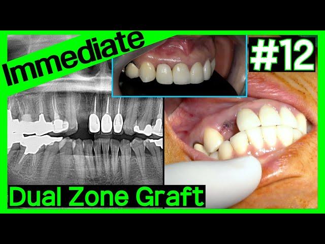 [Online Surgery] Immediate implant on #12 & dual zone graft