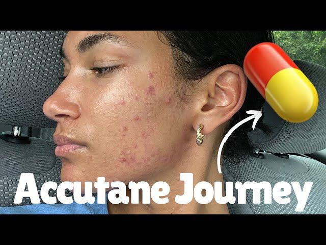 Starting my ACCUTANE journey (Isotretinoin) | Accutane side effects & process