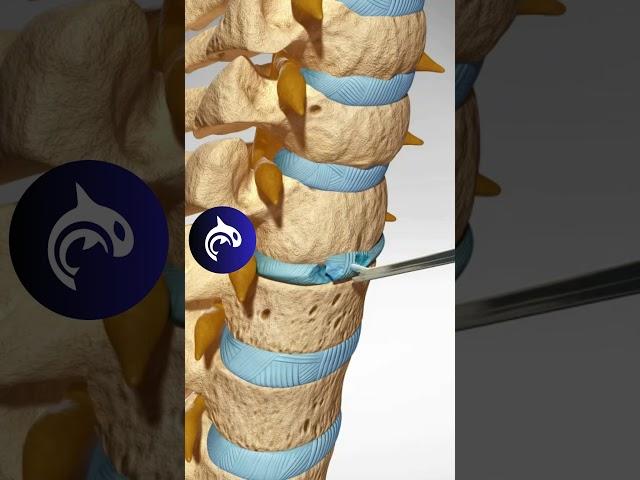 See how an Artificial Cervical Disc Replacement of the Spine works in 3D animation.