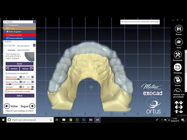 Placa miorrelaxante + Articulador Virtual | Alexandre Matias Dental Designer  | Exocad