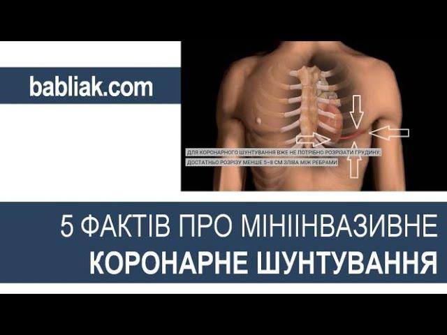 5 фактів про мініінвазивне коронарне шунтування