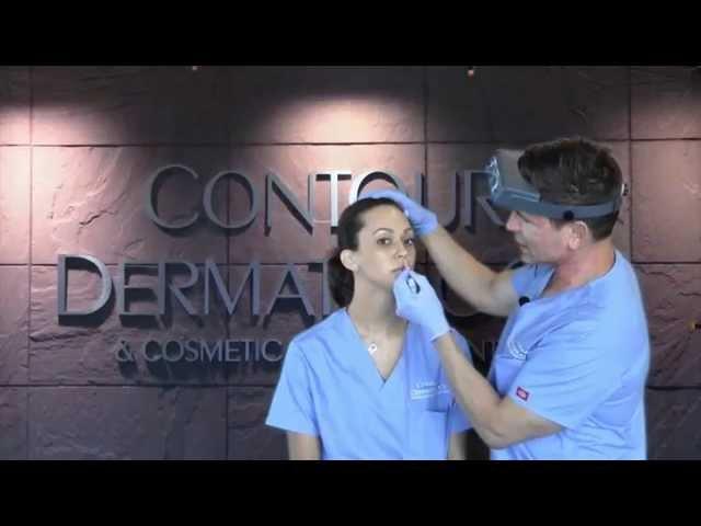 Dr. Timothy Jochen demonstrates Lip Enhancement with Perlane