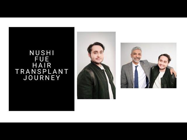 Nushi FUE Hair Transplant- Parsa Mohebi Hair Restoration