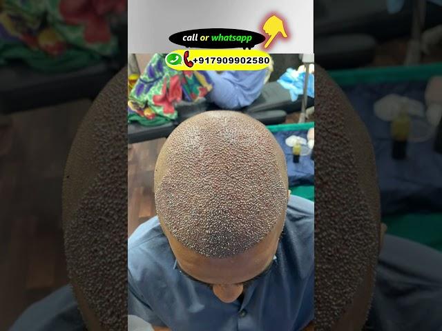 UNBELIEVABLE HAIR TRANSPLANT RESULT IN INDIA ||#shorts