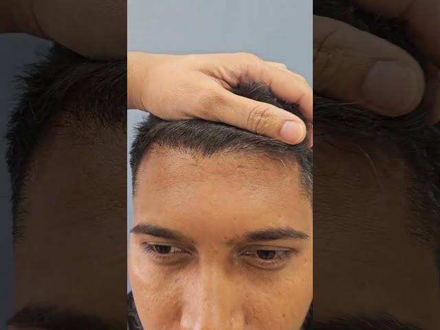 6th Month post Hair Transplant...fabulous transformation..