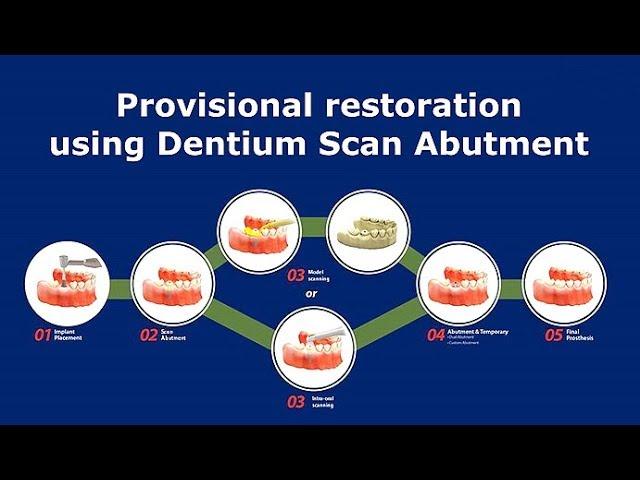 Provisional restoration using Dentium Scan Abutment