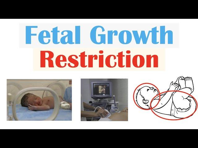 Fetal Growth Restriction (FGR, IUGR) | Types, Causes, TORCH Infections, Diagnosis, Treatment