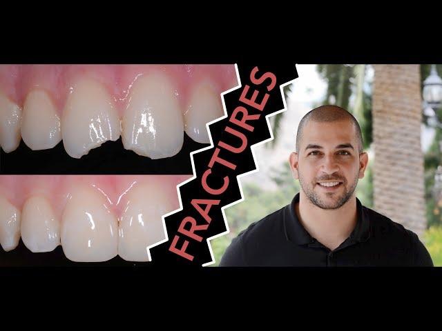 How to Repair a Broken Tooth with Dentist Filling (Dentist)