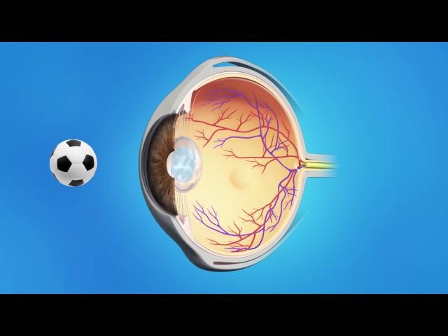 YAG Capsulotomy After Cataract Surgery