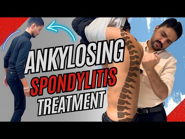 How Chiropractor Help Manage Ankylosing Spondylitis | Dr. Harish Grover