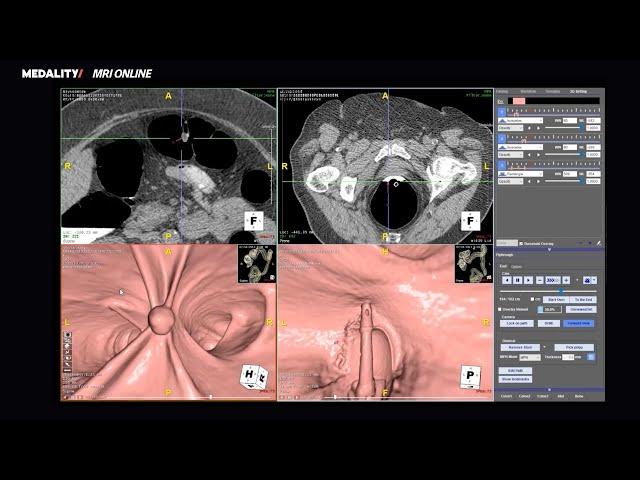 Screening CT Colonography Radiology Course Preview - Medality (formerly MRI Online)