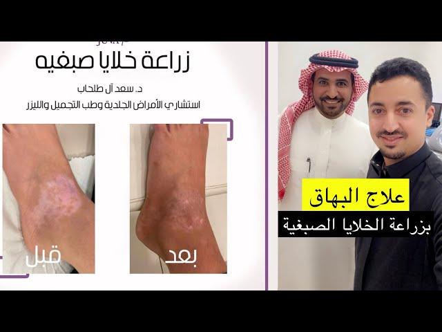 علاج البهاق |  بزراعة خلايا صبغية