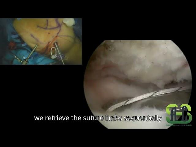 Arthroscopic Rotator Cuff Repair: Easy Subacromial Access & Double Row Technique / mango rotador