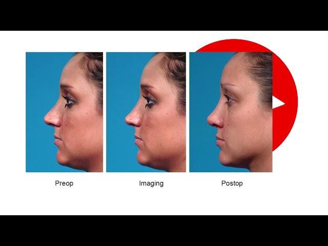 3D-Printed Noses. Plastic Surgery Hot Topics with Rod J. Rohrich, MD