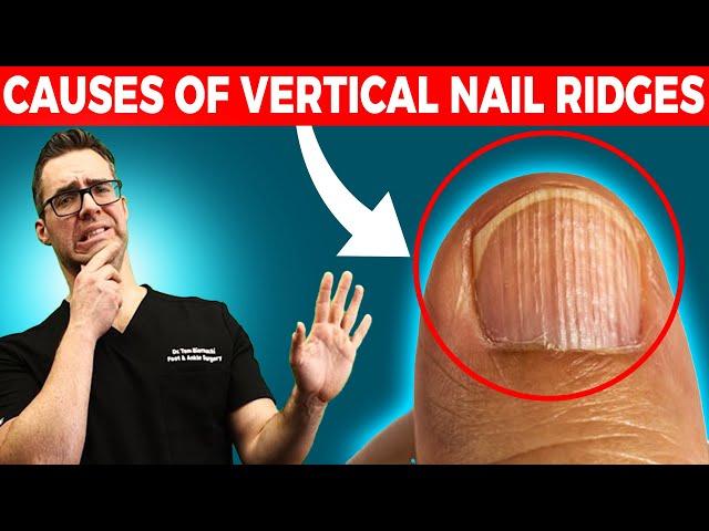 Do you have Vertical Nail Ridges?  [Causes & Treatment]