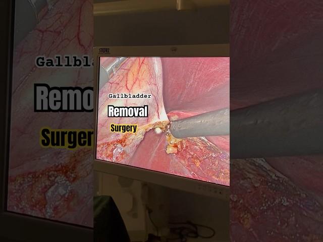 Gallbladder Stones removal Treatment I Operation I Gallstones Surgery