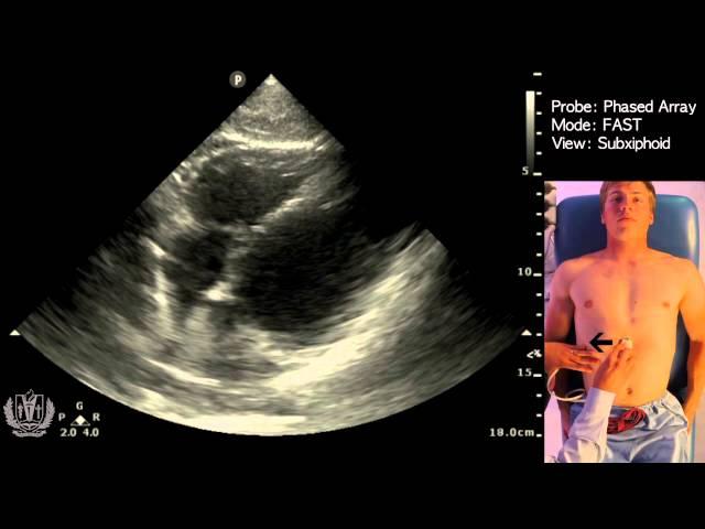 FAST Scan (Focused Assessment with Sonography in Trauma) - STEP by STEP