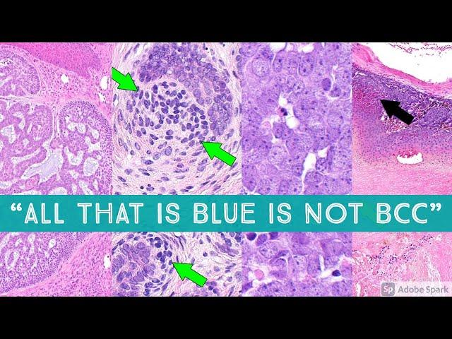 "All that is Blue is Not Basal Cell Carcinoma" - BCC vs Mimics - Dermpath Dermatology Pathology