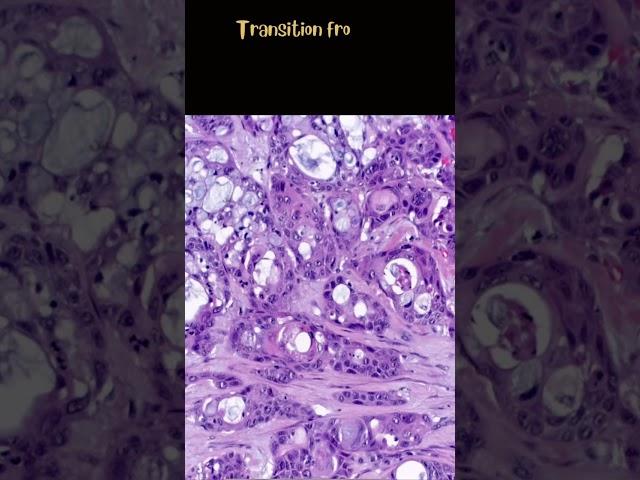 Gastric adenosquamous carcinoma