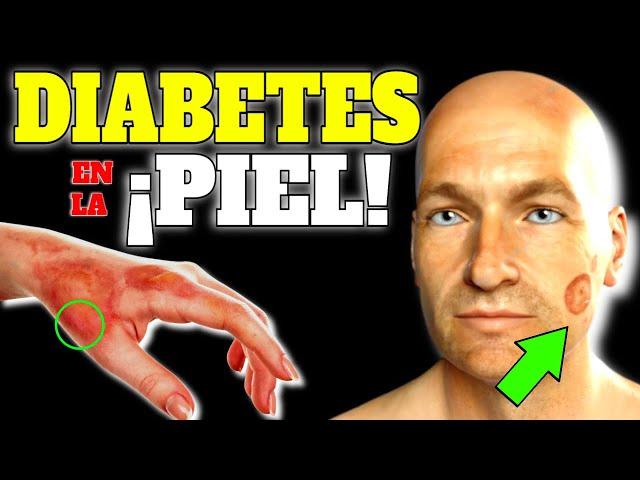 FIRST SYMPTOMS of DIABETES on the SKIN!