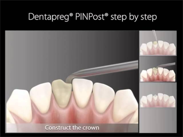Dentapreg PinPost Training