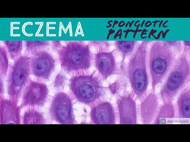 Eczema/Atopic, Contact Dermatitis, etc: Spongiotic Dermatitis Pattern - Inflammatory Dermpath Basics