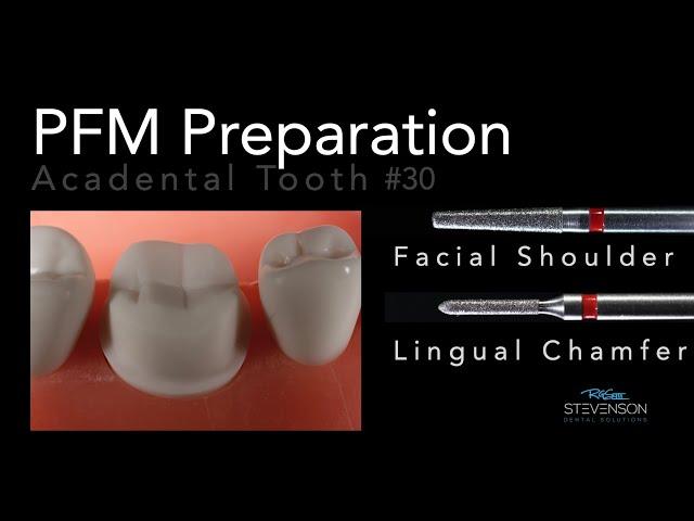 PFM Preparation - Acadental Tooth #30 | Dr. Richard Stevenson