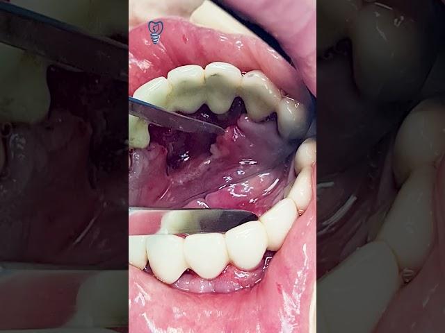 Зубной камень захватил полость рта. Tartar has invaded the oral cavity.