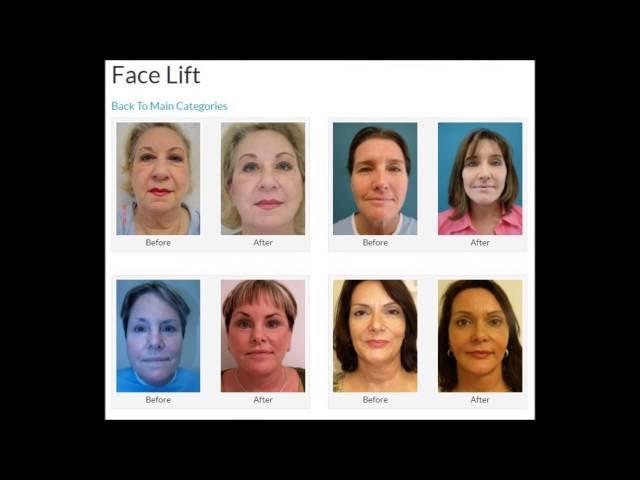 Best Facelift Surgery Doctor in Boca Raton | Facial Plastic Surgeon FL