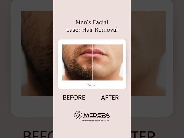 Men’s Facial Laser Hair Removal in Toronto